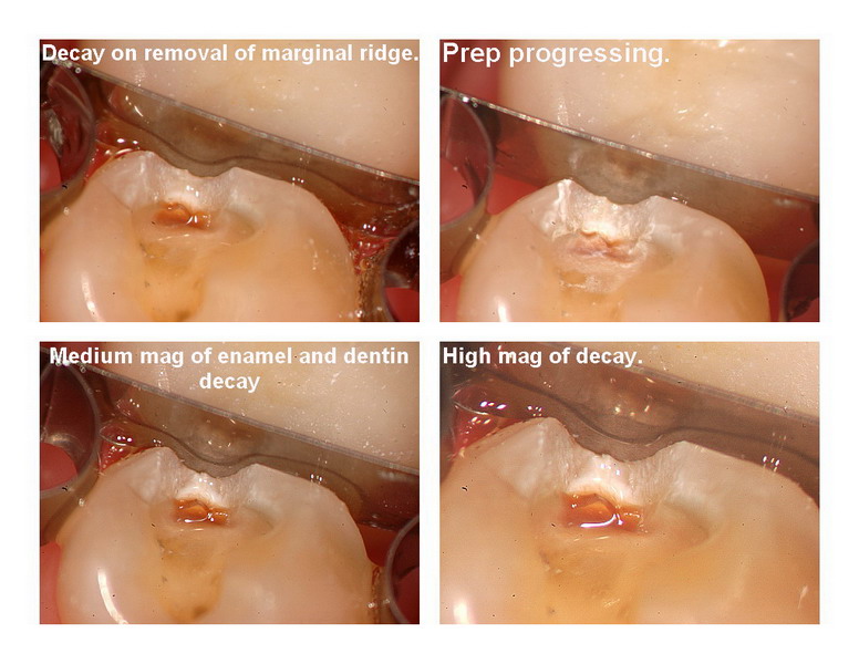 Amalgam removal 3_resize.jpg